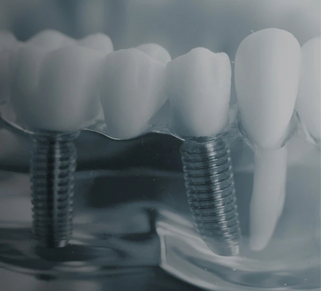 インプラント治療